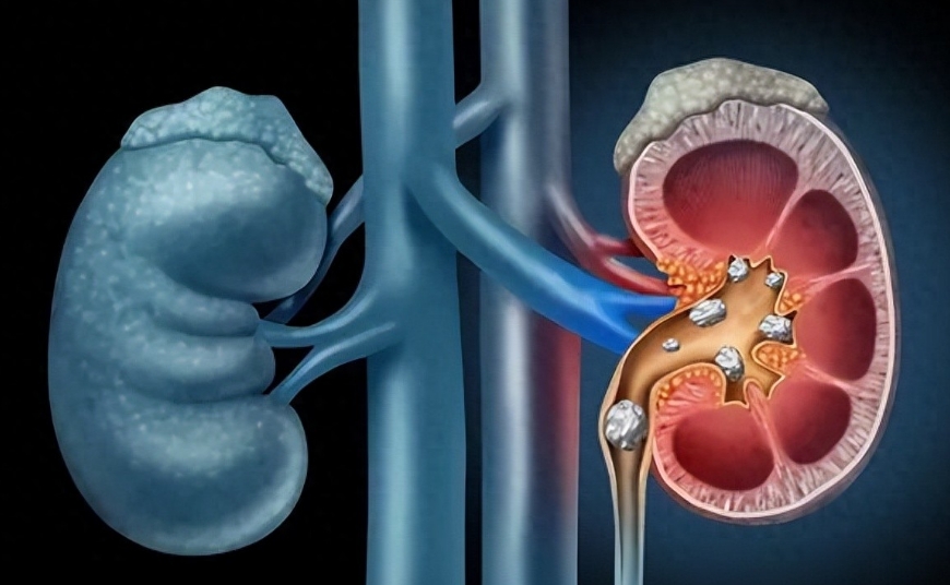 结石不痛也要关注！肾积水等导致肾功能永久性丧失